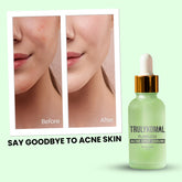 acne spot serum benefits